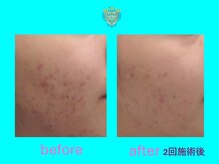 リュクス(LUXE)/ビフォーアフター2回