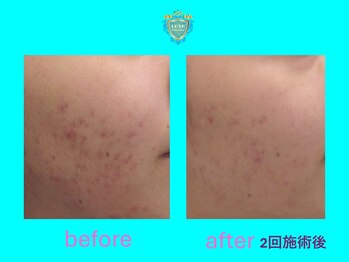 リュクス(LUXE)/ビフォーアフター2回