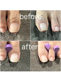 巻き爪で痛みの方は当店へ♪