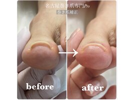 巻き爪補正【初回】