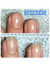 桃の木 吉祥寺店/二枚爪は乾燥が原因の事が多い