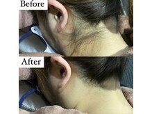 ビマナ 小岩店(NU美Mana)/【うなじ脱毛】