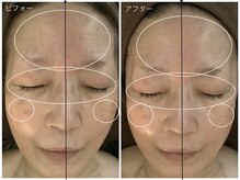 アクア エステティコ 亀有(ACQUA estetico)/小顔エイジングケア目元美容液　