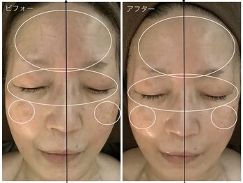 アクア エステティコ 亀有(ACQUA estetico)/小顔エイジングケア目元美容液　