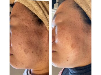 サロン ギフト(Gift)/肌質改善!純粋レチノールピール