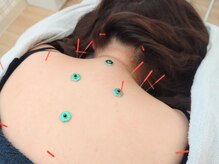 小林はり灸/はり灸