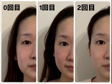 キプラ 福津店(KIPURA)/小顔矯正2回目