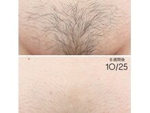 リアン(Rian)の雰囲気(人気No.1のVIOダブル脱毛 / 高品質のwax剤6種を常備)