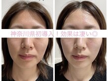 サクラ(SAKURA)/小顔・小顔・小顔ならお任せを