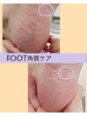 【角質ケア】ビフォーアフター