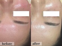 エステサロン ジョアアンジェ(joie ange)/ララピールでツヤ肌に◎