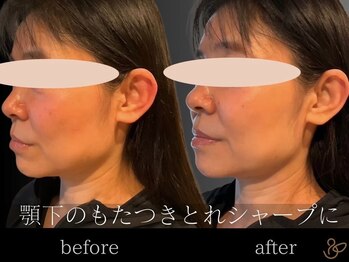 チョコバリ 郡山店(chocobari)/小顔×リフトアップ(美容鍼)30代