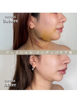 術後の女神 大阪心斎橋店/術後ケアインディバ・インディバ