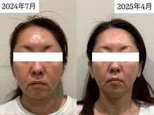 マカオン(machaon)/【小顔リフト】小顔マッサージ