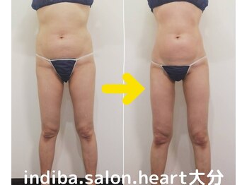 ハート 大分(heart)の写真/INDIBA専門人気No.１痩身！大分で唯一無二の温活＆代謝アップで、理想のサイズダウンへ導きます♪