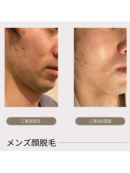 レイール(Reir)/メンズ顔脱毛 before→after