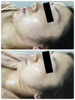 メイユール(MEILLEUR)/光フェイシャル