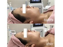 エミット(emit.)/フェイスラインスッキリ