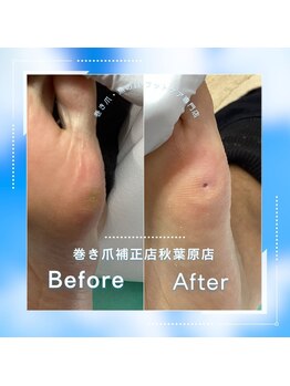 巻き爪補正店 秋葉原店/【硬いタコ/魚の目ケア】