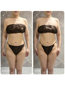 インディバ 六本木/【上半身集中】before→after