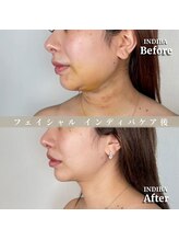 術後の女神 大阪心斎橋店/術後ケアインディバ・インディバ