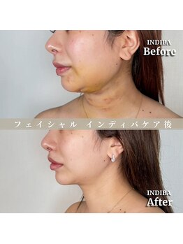 術後の女神 大阪心斎橋店/術後ケアインディバ・インディバ