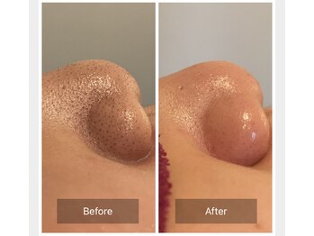 リジュベ(Rejuve)/毛穴エクストラクション[本八幡]