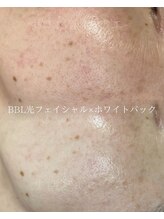 アエ(ae)/BBL×ホワイトパック