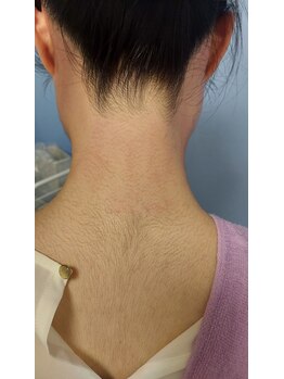 キアラ 麻布十番(Kiara)/うなじ脱毛