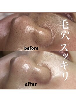 ビューティーネイル(Beauty Nail)/毛穴エクストラクション