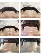 美バストアルファ(美bust α)/【バストアップ】症例