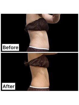 クールヴィラ(Cool Villa)/へそ上下2カップ&テスラ