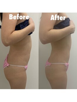 ビノス 福井店(VINOS)/痩身のビフォーアフターです☆彡