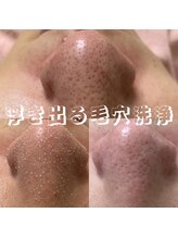 悠癒/韓国式3D毛穴洗浄