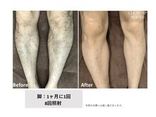 エミルカ(EMILUCA)/メンズ両足脱毛