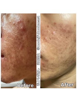 ミミルーチェ(mimiluce)/ニキビケアは血流が大事