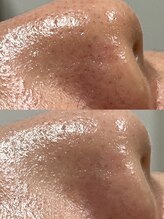 アットウィル 志木店(at will)/毛穴洗浄Before after