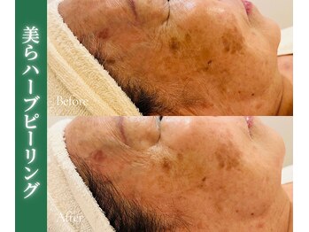 アイランドハーブ 沖縄おもろまち店/ハーフピーリング