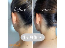 エピナス 大和店/効果すごい！うなじW脱毛で減毛