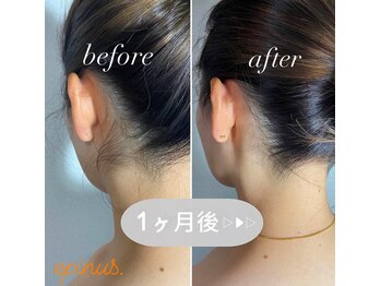 エピナス 大和店/効果すごい！うなじW脱毛で減毛