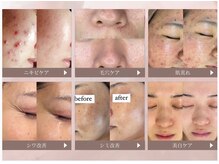 ホワイトアクア 高槻店(WHITE AQUA)の雰囲気（毛穴・ニキビケアに!芸能人御用達『REVI ハーブピーリング』）