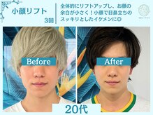 フローフシ∞/【小顔】切らない小顔リフト
