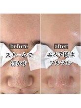 ニュートラル(neutral)/毛穴エクストラクションプロ大分