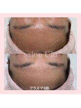 ウル(Ulu)/赤み毛穴透明感