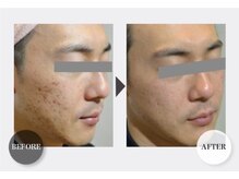 インナーメス(INNER MES)/気になるお肌に肌質改善