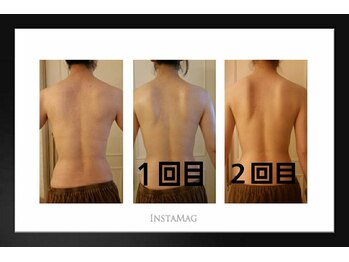 ココサロン(Coco Salon)/背中トリートメントビフォアフ★