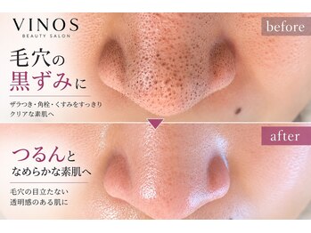 ビノス 高岡店(VINOS)の写真/【ハイドロフェイシャル毛穴洗浄★】頑固な毛穴汚れに徹底アプローチ!更にララピールで毛穴レス肌に♪