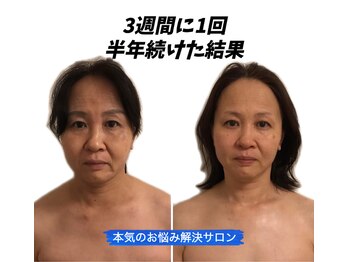 ココ(coco)/大好評♪小顔リフト&ラジオ波