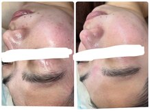 エルマナ(Hermana)/小顔美白ビフォーアフター