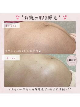 イリゼ(IRISE)/自己処理の難しい「お腹の脱毛」